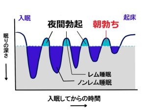 夜間陰茎勃起現象(NPT)